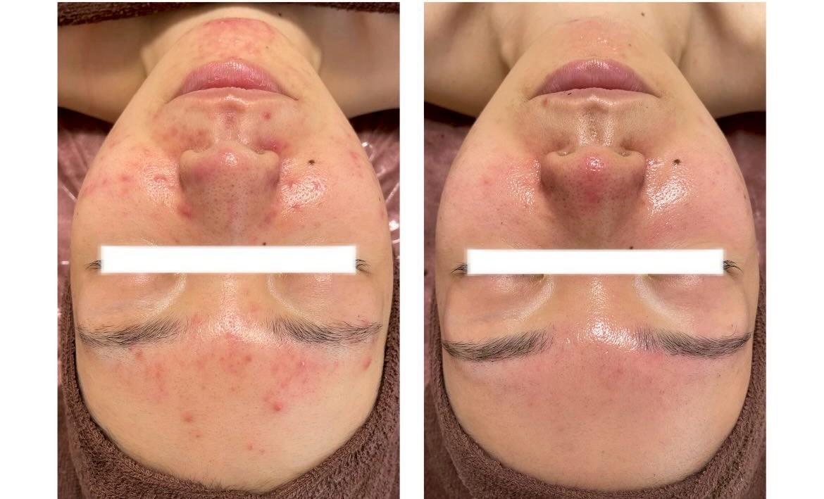 ハーブピーリングのビフォーアフター