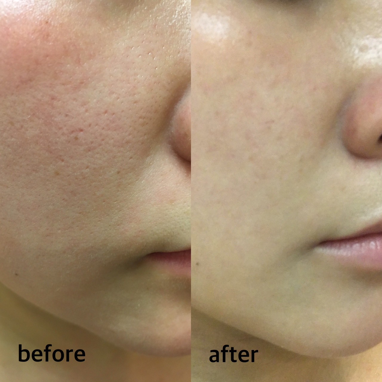 ハーブピーリングのビフォーアフター